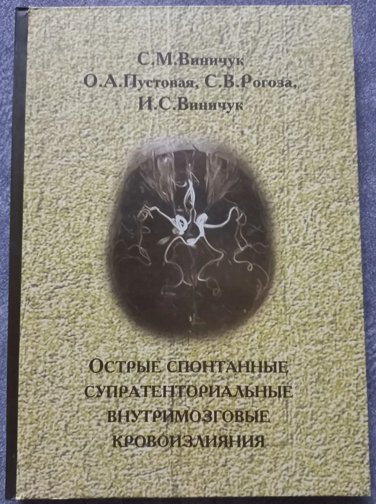 Острые спонтанные супратенториальные внутримозговые кровоизлияния