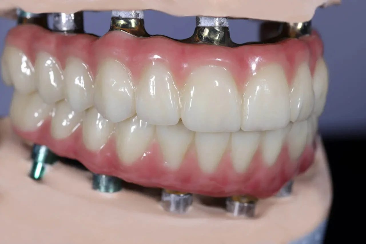 Незнімне протезування,фрезерування о цирконію,Е-мах,CAD/CAM,3Dдрук 5