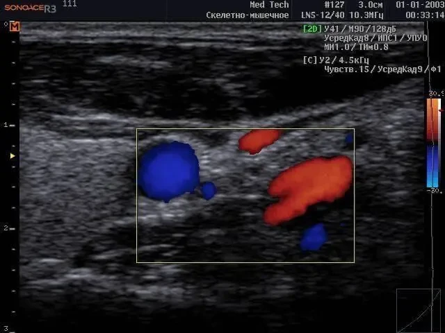 УЗИ УЗД Samsung Medison Sonoace R3/ 2013 рік Доплер/ 2 датчики 6