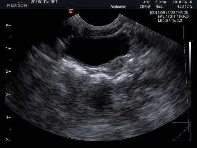 УЗИ УЗД Samsung Medison Sonoace R3/ 2013 рік Доплер/ 2 датчики 3