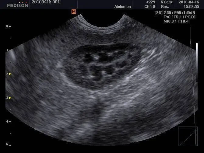 УЗИ УЗД Samsung Medison Sonoace R3/ 2013 рік Доплер/ 2 датчики 5