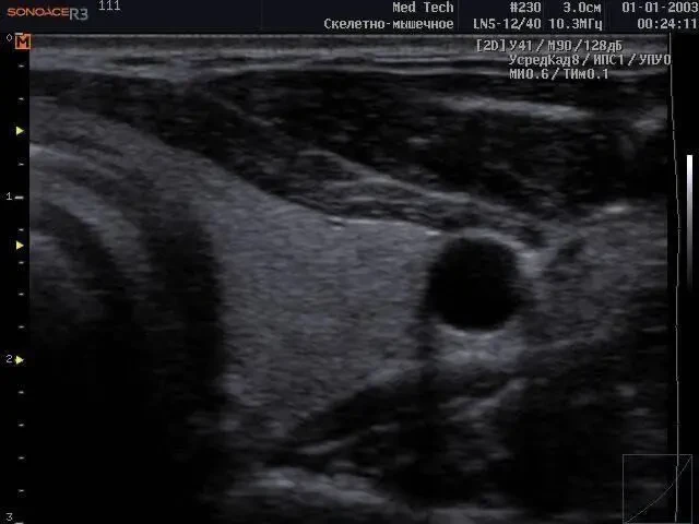 УЗИ УЗД Samsung Medison Sonoace R3/ 2013 рік Доплер/ 2 датчики 7