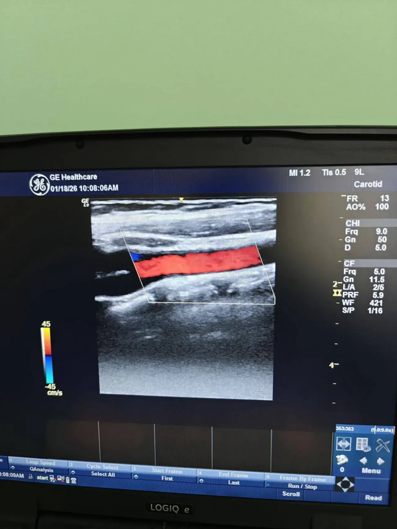 ДАТЧИК УЗИ УЗД ЛІНІЙНИЙ GE 9L-RS 2017 РОКУ ФОТО  ВІДЕО РОБОТИ/ 4